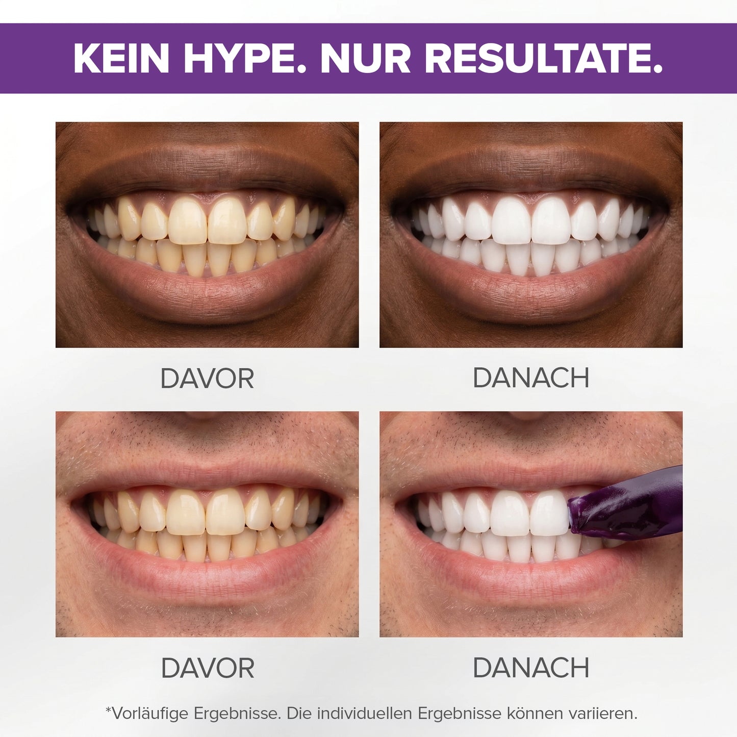 smilelux™ Violet Pro Zahnaufhellungsstreifen